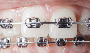 Handling Orthodontic Issues at Home
